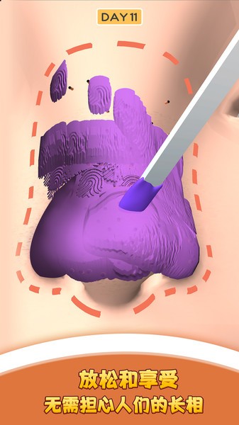 我爱挤黑头游戏下载